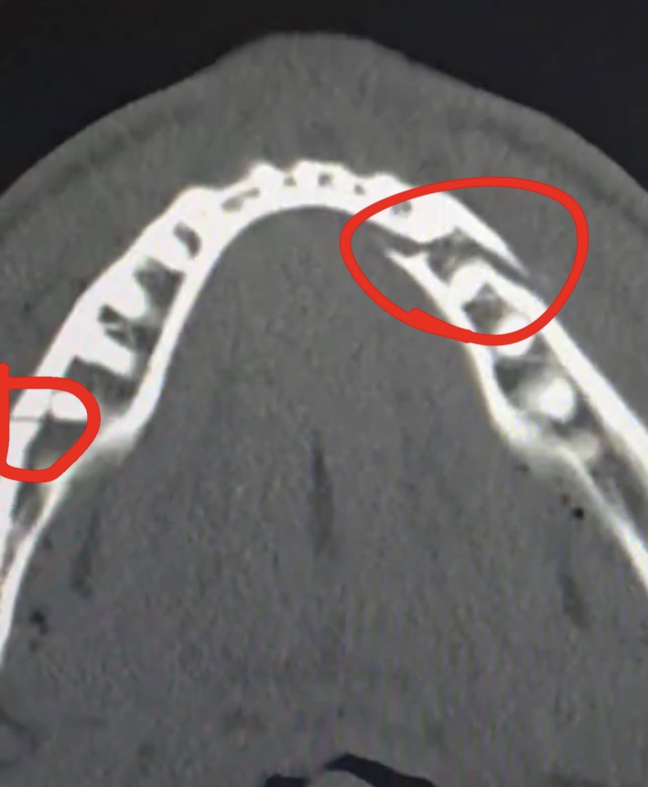 “Double broken jaw”: Jake Paul shows the damage from the Joshua fight